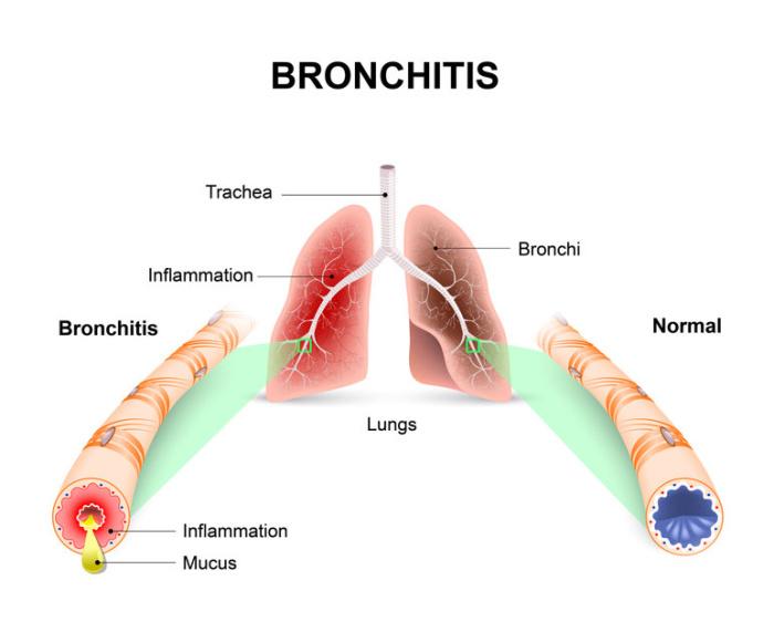 bronchite sintomi e rimedi cure naturali it