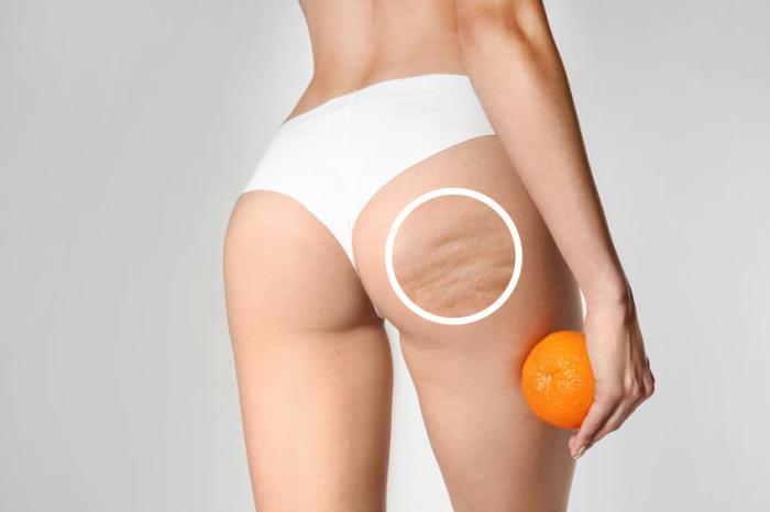 cellulite