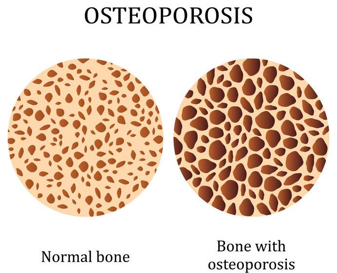 osteoporosi